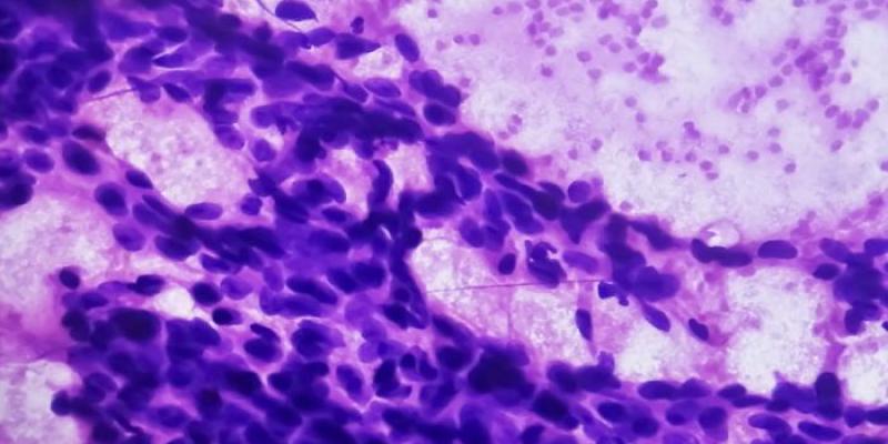 Un tumor mamario que muestra carcinoma ductal | Foto del CSIC