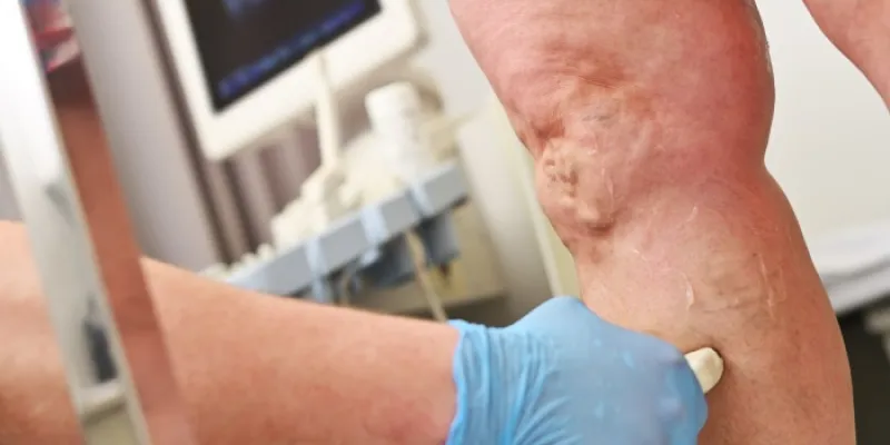 Varices