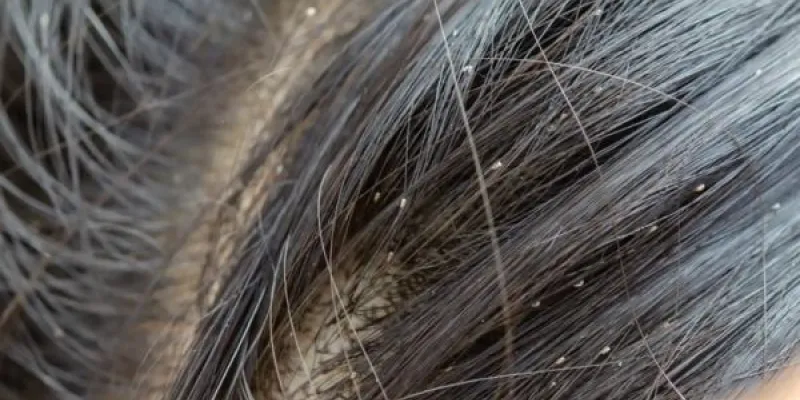 Los mejores trucos para prevenir los piojos.