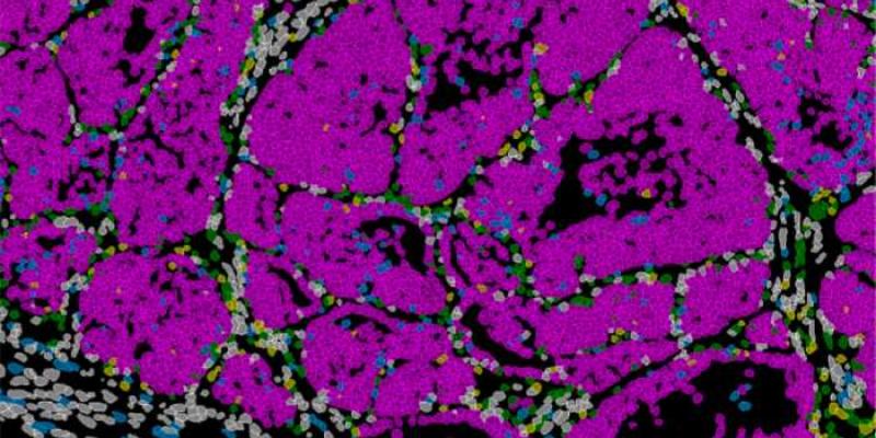 Tumor de mama en ratón con células cancerosas (rosa) 