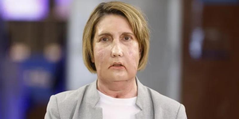 Carmem receptora del primer trasplante de cara del mundo