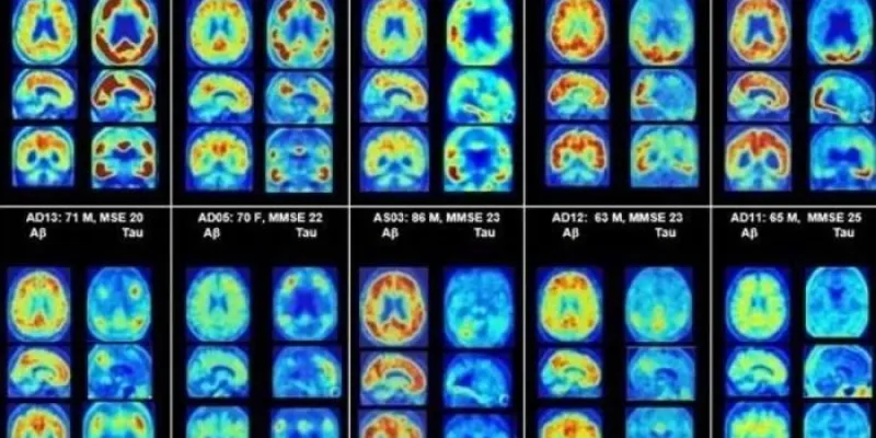 Imágenes de pacientes con Alzheimer