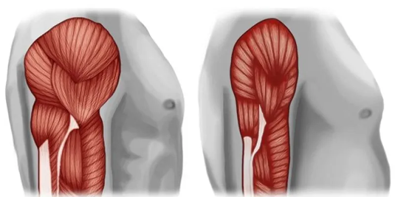 Sarcopenia, afección en los músculos