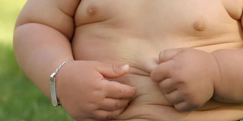 Niño con Síndrome Prader Willi
