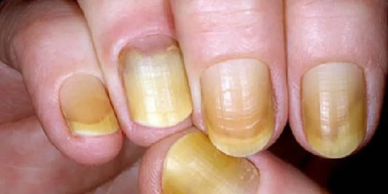 Síndrome de las uñas amarillas