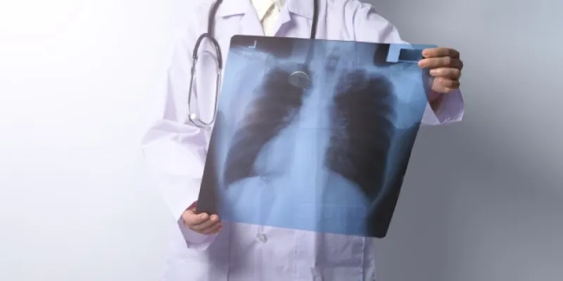 Radiografía de cáncer de pulmón