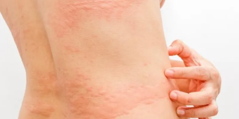 Urticaria en el tronco