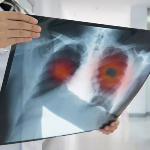 Encuesta sobre cáncer de pulmón