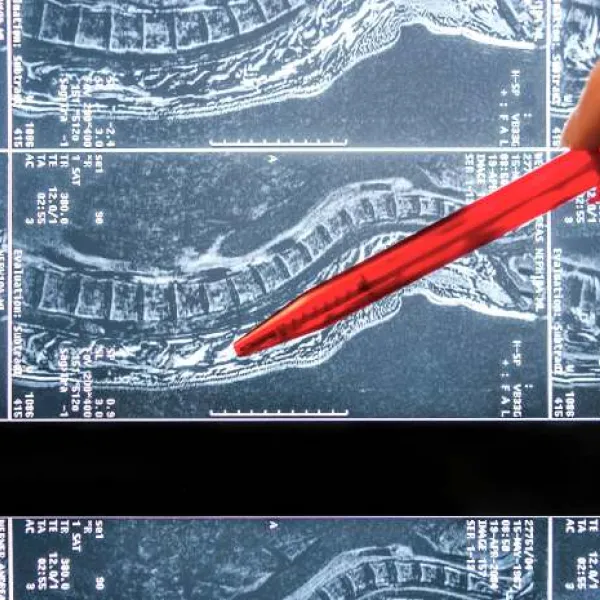 Una neurocirujana señala la zona del daño medular