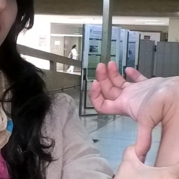 Mujer con el Síndrome de Ehlers-Danlos