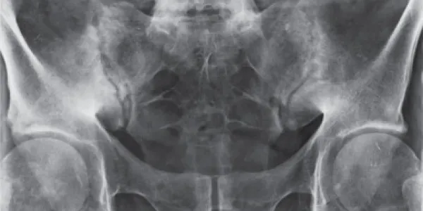 Radiografía de una mujer con espondiloartritis axial