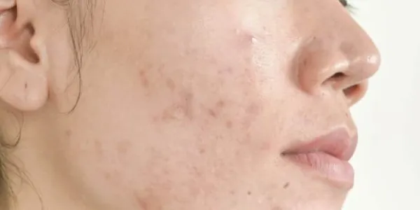 Acné en rostro