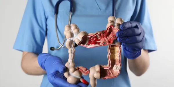 cáncer de colon
