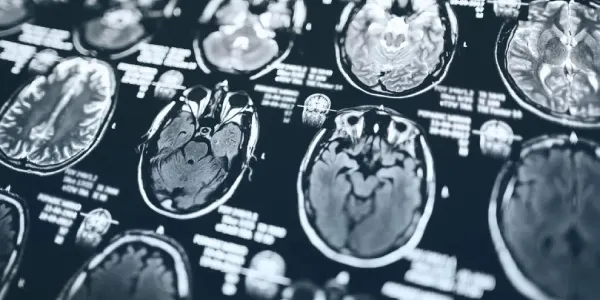 Radiografía del cerebro