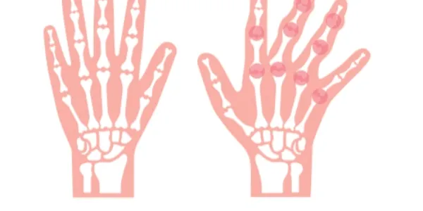 Ejemplo de artritis psoriásica