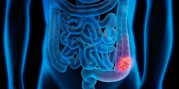 Cáncer colorrectal