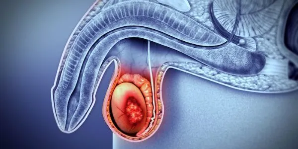 Cáncer de testículo en España