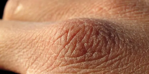 Xerosis