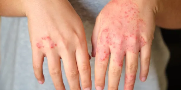 dermatitis atópica