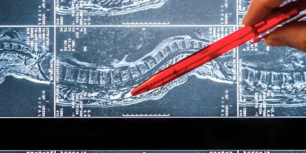 Una neurocirujana señala la zona del daño medular 