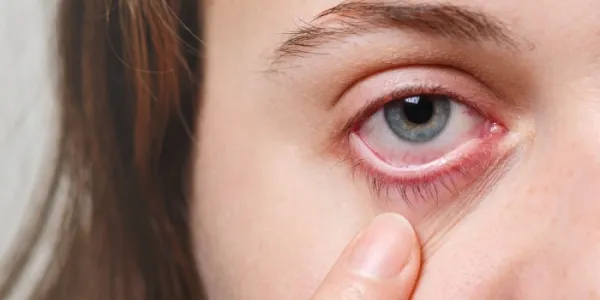 Mujer con aniridia 