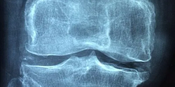 Osteoporosis/Pixabay