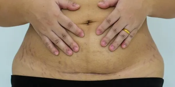 La diástasis abdominal puede ocurrir durante y después del embarazo