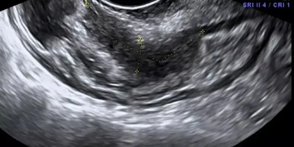 Endometrio tras una ecografía