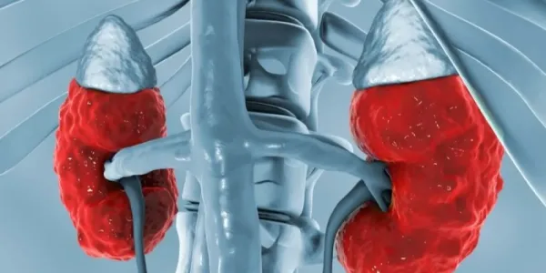 Enfermedad renal