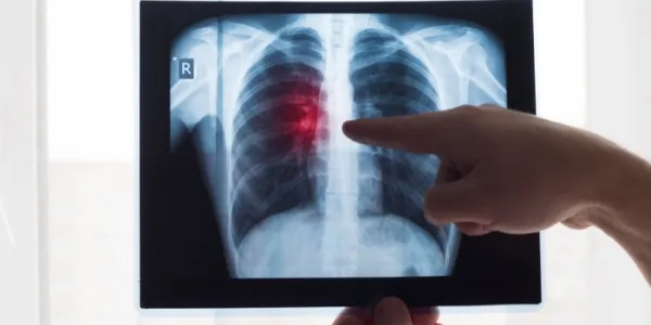Radiografía de cáncer de pulmón