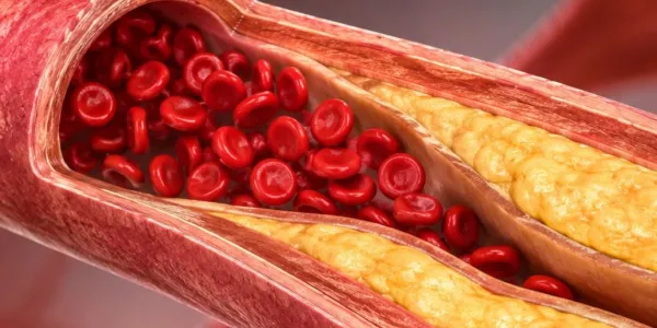 Hipercolesterolemia