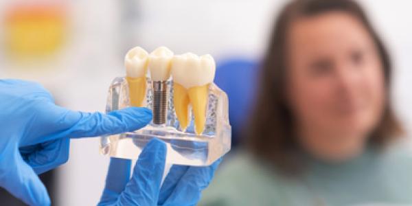 La importancia de cuidar los implantes dentales