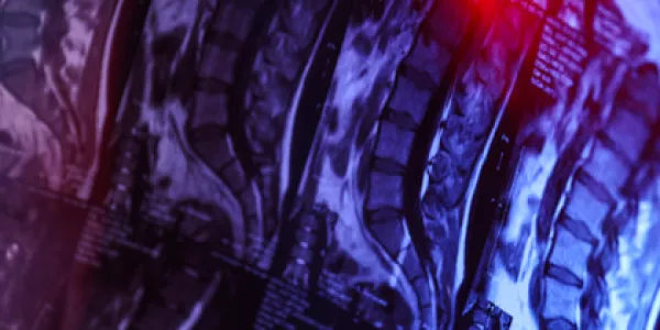 Lesiones medulares y avances