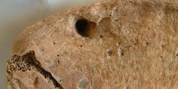 Mordedura en la cadera del gladiador, concretamente en la cadera