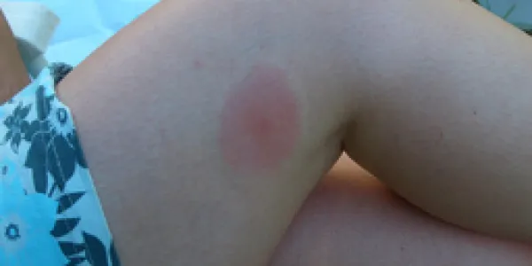 Picaduras de mosquitos en verano