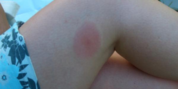 Picaduras de mosquitos en verano