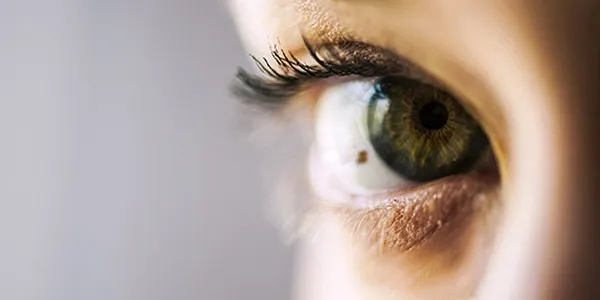 Nevus oculares o lunares en los ojos
