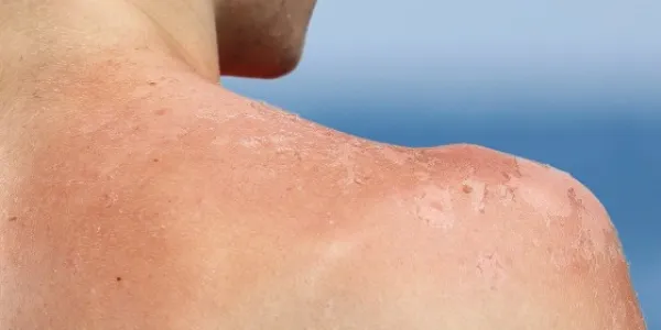 Daño solar en la piel