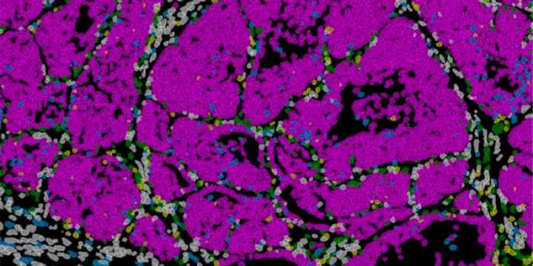 Tumor de mama en ratón con células cancerosas (rosa) 