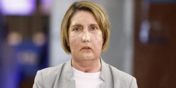 Carmem receptora del primer trasplante de cara del mundo