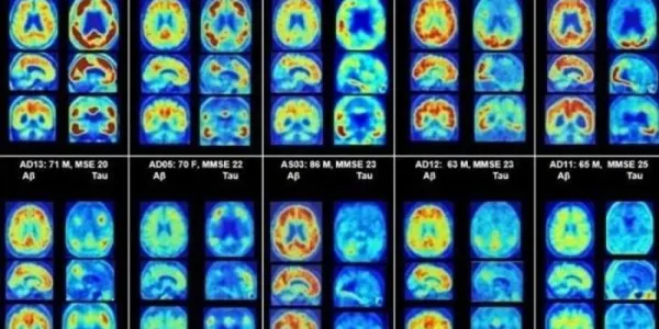 Imágenes de pacientes con Alzheimer
