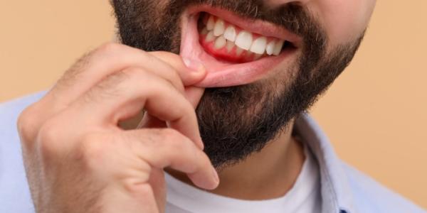 hombre con la encía inflamada