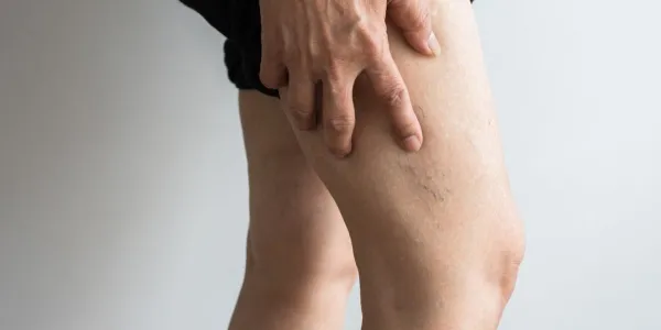 Tipos de trombos y consecuencias