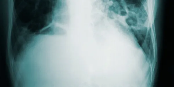 Hallan un tratamiento más eficaz contra la tuberculosis. Foto: @cdc en Unsplash