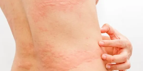 Urticaria en el tronco