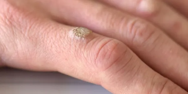El VPH también se transmite por las uñas y los dedos