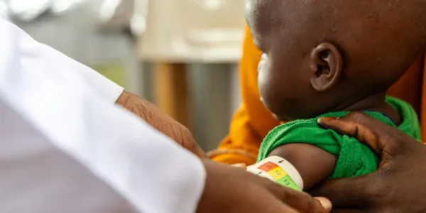 Niño con desnutrición infantil